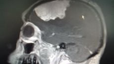 一附院外六科成功为一患者切除矢状窦傍巨大脑膜瘤