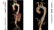 一附院外七科完美的演绎了一例升主动脉、主动脉弓、降主动脉及腹主动脉的高难度的血管腔内治疗手术